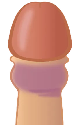カントン包茎の状態を示すイラスト