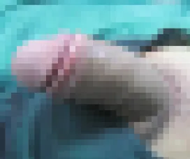 case 02（40代 男性）施術後の症例写真（モザイク処理済み）
