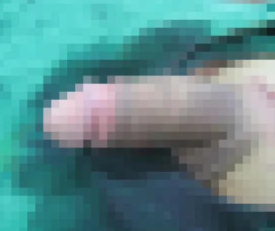 case 03（包茎術3か月後）施術後の症例写真（モザイク処理済み）