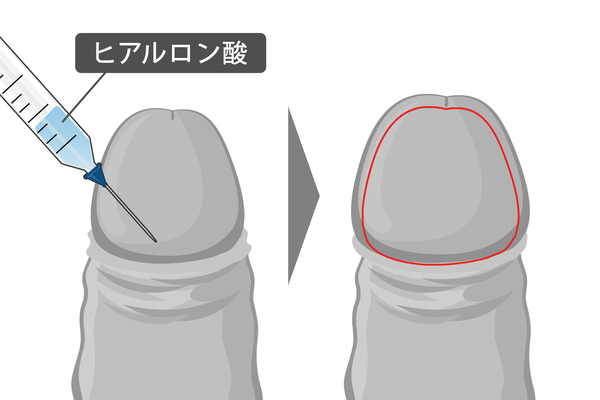 亀頭増大治療