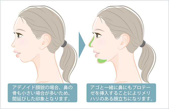 アゴ プロテーゼ挿入 美容整形外科のジョウクリニック