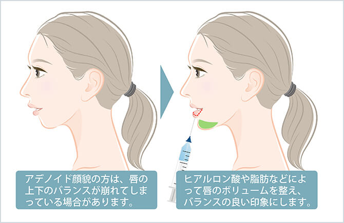顎プロテーゼ挿入+口唇ヒアルロン酸注入・脂肪注入