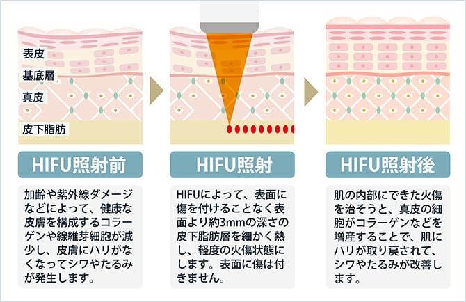 医療用 HIFU(ハイフ)照射前後