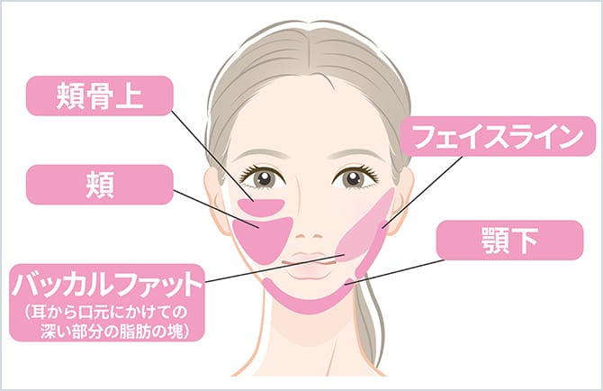 クールスカルプティング（脂肪冷却） | 美容整形外科のジョウ