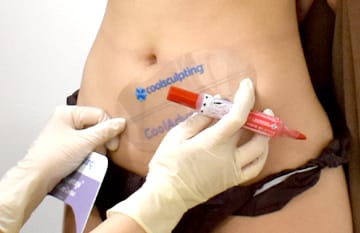 施術部位の確認マーキン