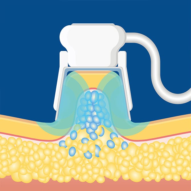 アプリケーターが施術箇所を吸引冷却するイメージ