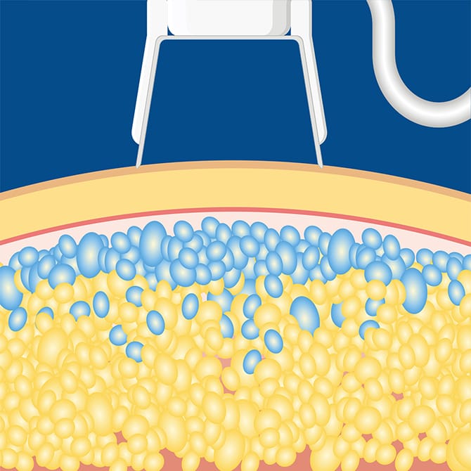 アプリケータによる吸引後