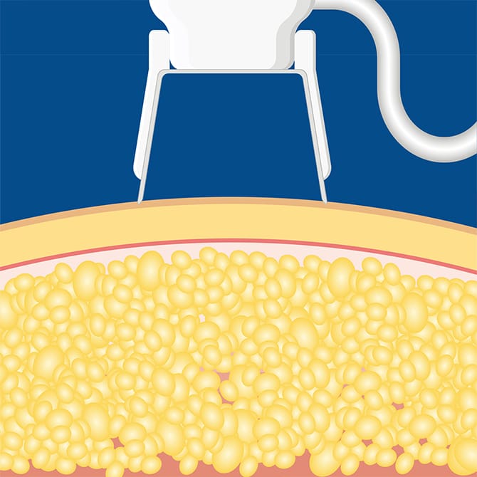 アプリケーターのセッティング