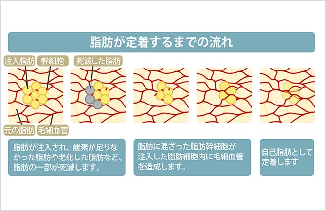脂肪が定着するまでの流れ