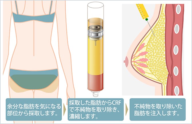 コンデンスナノファット注入