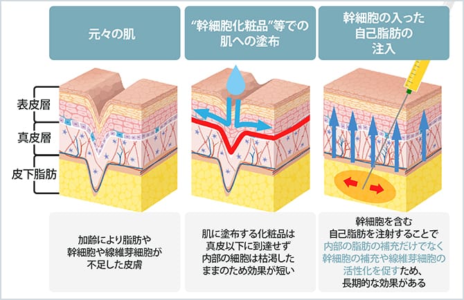 「脂肪幹細胞」の力で美肌効果も期待できる