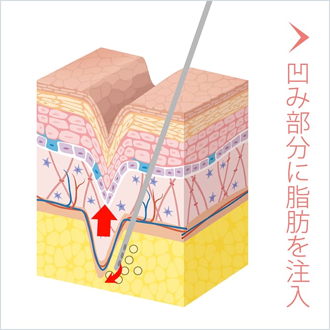 凹み部分に脂肪を注入