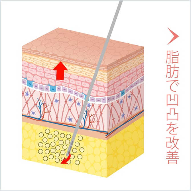 脂肪で凹凸を改善