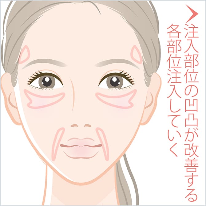 注入部位の凹凸が改善する各部位注入