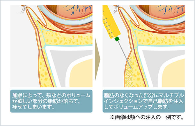 マルチプルインジェクションの例