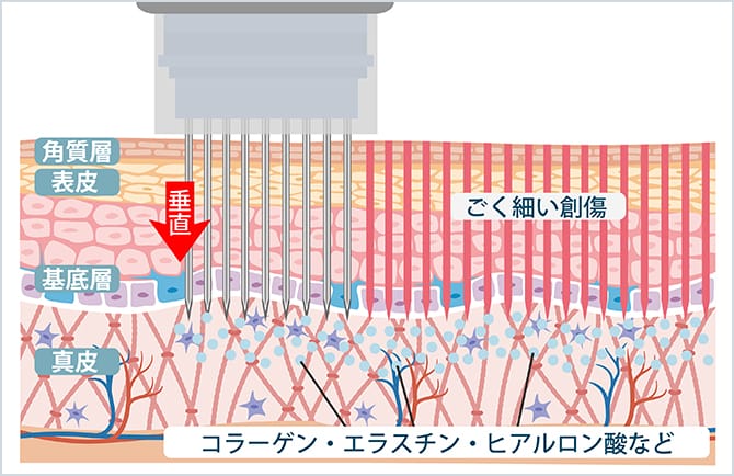 ダーマペン治療