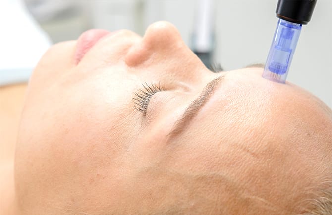 ダーマペン4の流れ