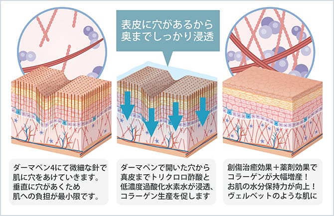ヴェルベットスキンの治療