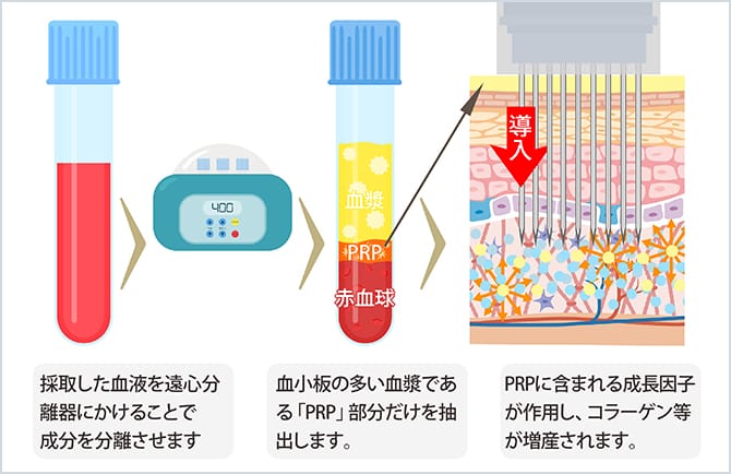 ヴァンパイアフェイシャル(PRP)の治療