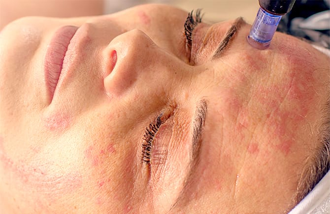 PRP療法の施術の流れ