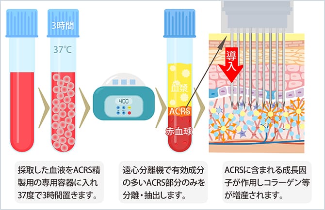 ヴァンパイアフェイシャルNEO(ACRS)の治療
