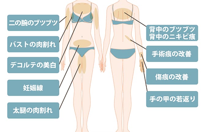 ダーマペン治療の体の適応部位