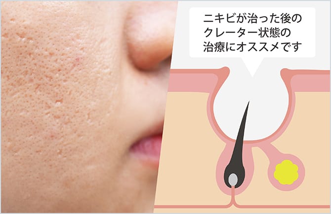 ニキビ痕のクレーター状態