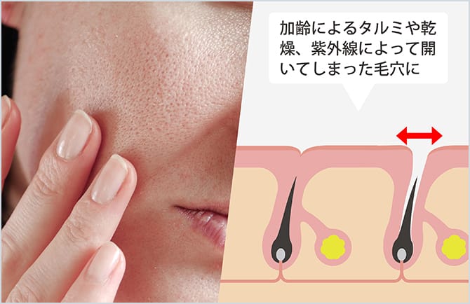 毛穴が開いている