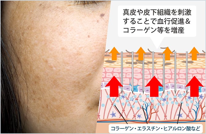 真皮や皮下組織を刺激して血行促進・コラーゲン等を増産する