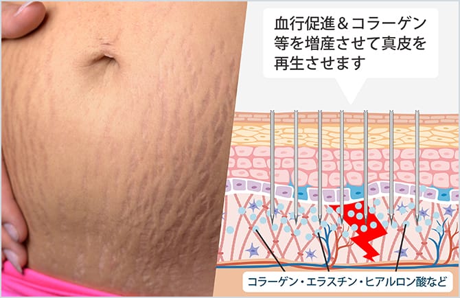 血行促進・コラーゲン等を増産させて真皮を再生させる