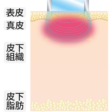 アプリケーターSRの使用イメージ
