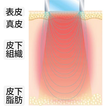 アプリケーターSRの使用イメージ