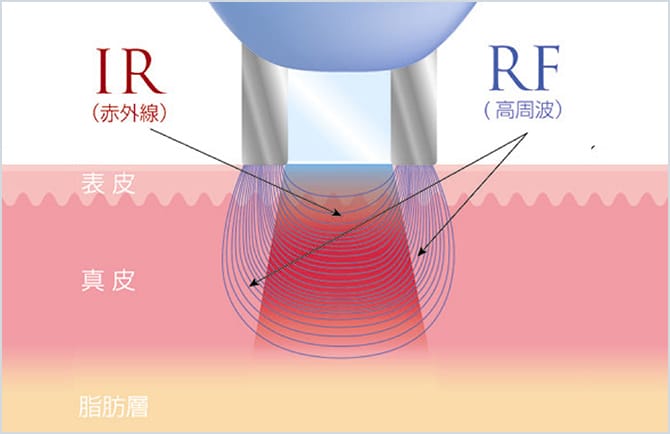 赤外線と高周波の皮膚への到達イメージ