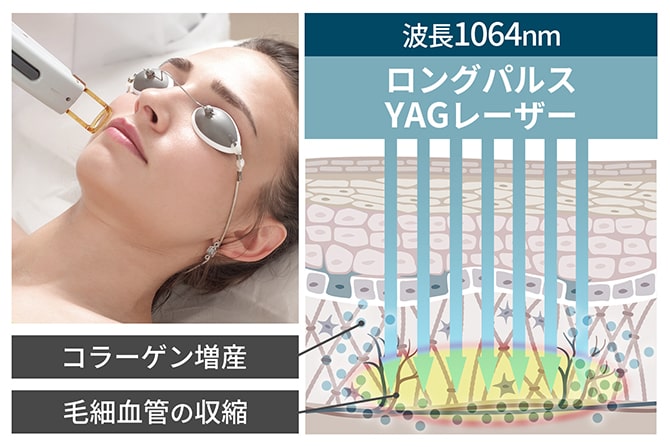 レーザーシャワーの説明