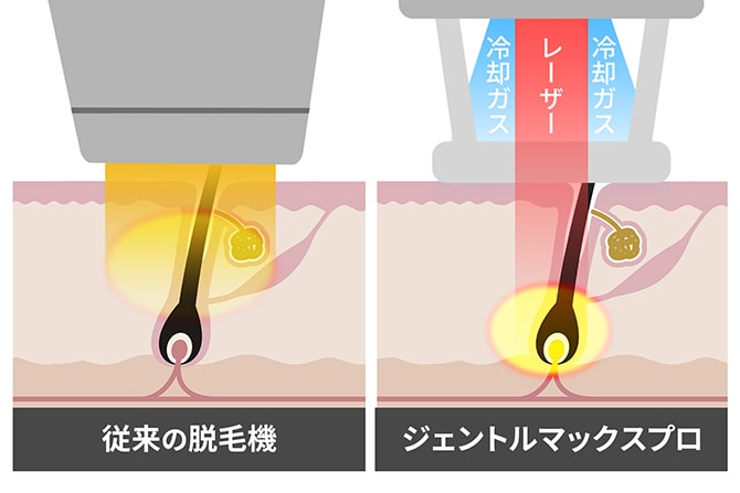 従来の脱毛器とジェントルマックスプロ