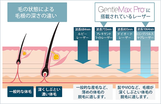 アレキサンドライトレーザー、ダイオードレーザー、YAGレーザー比較イメージ図