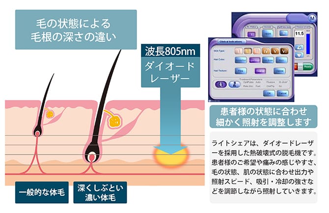 ライトシェアデュエット照射面の画像