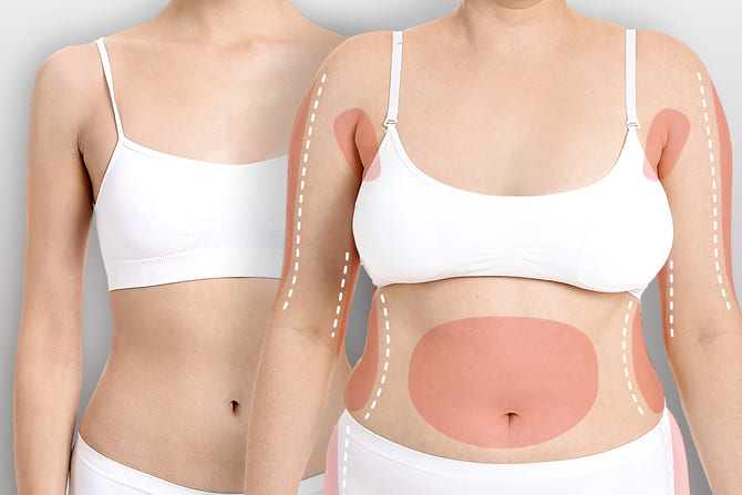 気になる部位から脂肪細胞吸引