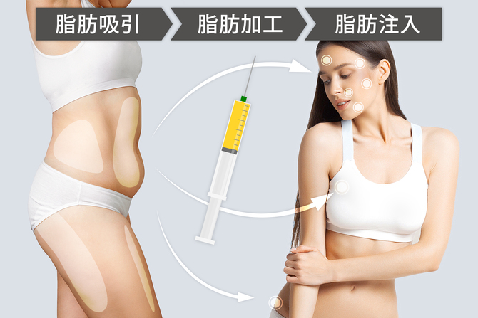 吸引した脂肪の使用も可能