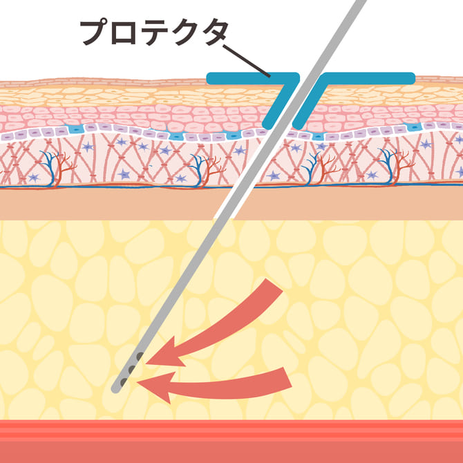 カニューレとプロテクターを使用して脂肪吸引