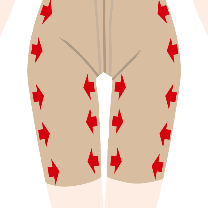 サポート下着で圧迫