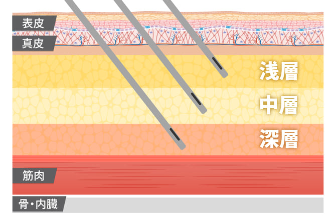 吸引する脂肪層の説明図