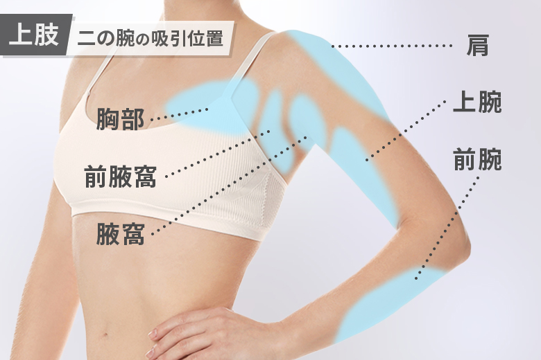 二の腕の脂肪吸引