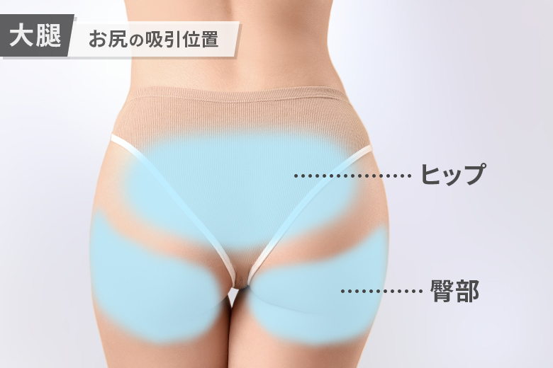 お尻の脂肪吸引