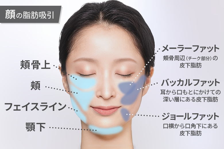 顔の脂肪吸引
