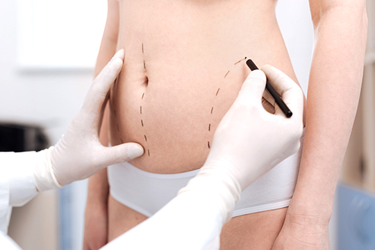 脂肪吸引の他院修正