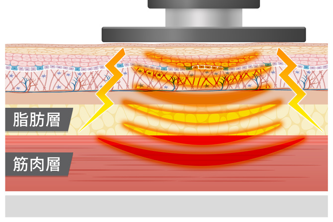 高周波温熱治療器の施術方法