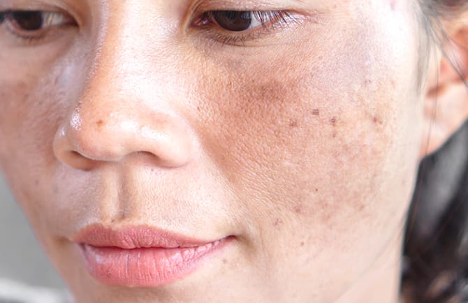 肝斑・シミコース