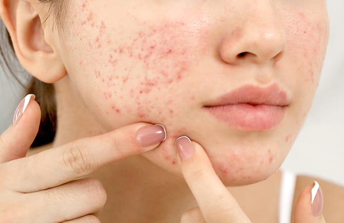 毛穴・ニキビコース