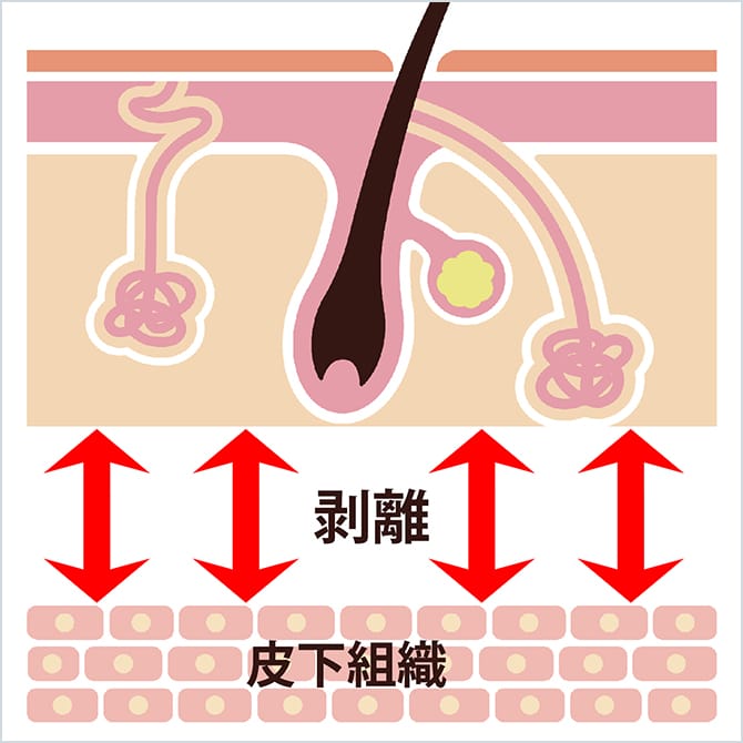 汗腺と皮下組織の間を剥離するイメージ